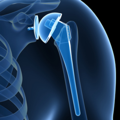 Arthroplasty Procedure