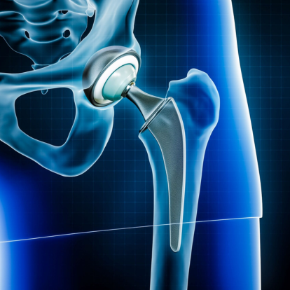 Hip Arthroplasty