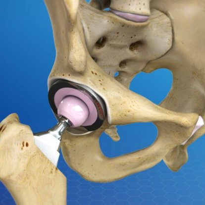 Total Hip Replacement Surgery