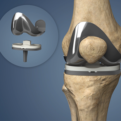 Total Knee Replacement Procedure