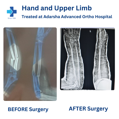 Upper Limb Surgery