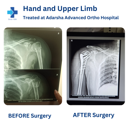 Upper Limb Surgery