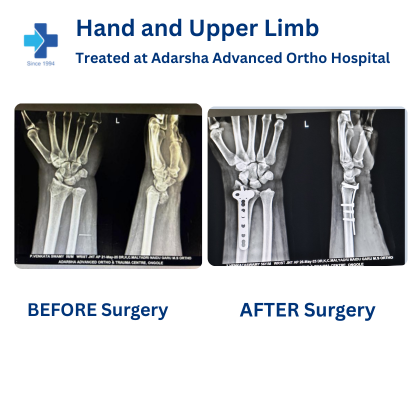 Upper Limb Surgery