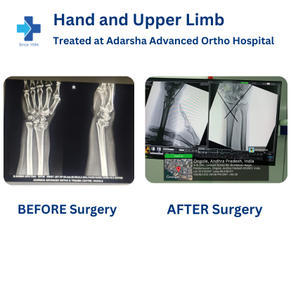 Upper Limb Surgery