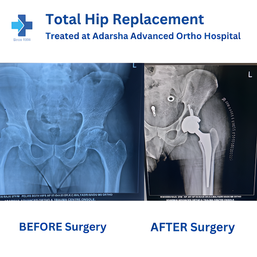 Total Hip Replacement Surgery
