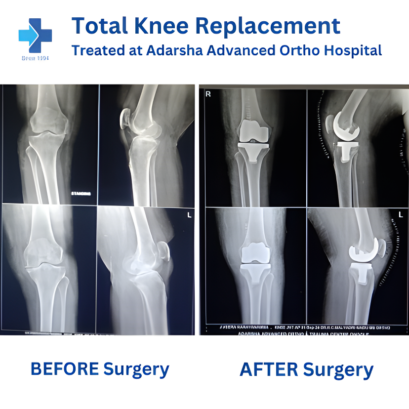 Total Knee Replacement Procedure