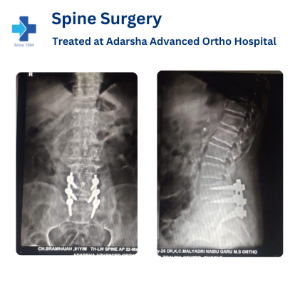 Spine Surgery